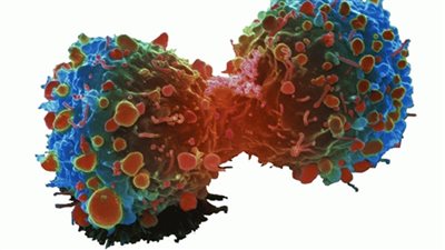 باحثون يقطعون خطوط الإمداد الغذائي للخلايا السرطانية لمنعها من النمو