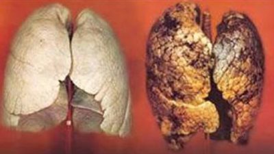 اختبار دم للكشف عن سرطان الرئة