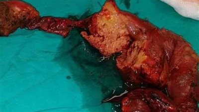 استئصال ورم خبيث لسيدة بمعهد الكبد القومي في المنوفية