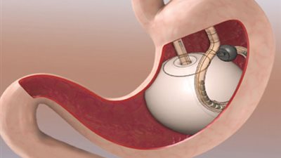 فوائد وأضرار بالون المعدة