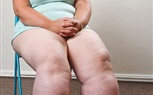 بالصور.. فتاة لديها مرض نادر يجعل ساقيها تتضخم